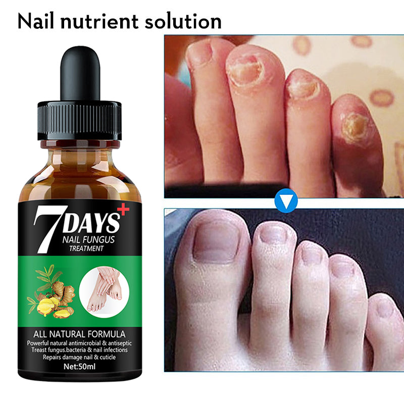 7 DAY  Nail Fungus Treatment Serum Care Hand And Foot Care Removal